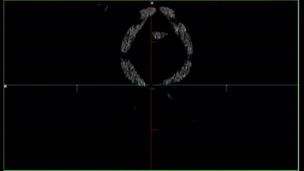 Tomografia Dane Diagnostyczne Rezonansu Magnetycznego Ekranie Laboratoryjnym Badań Nad Chorobami — Wideo stockowe