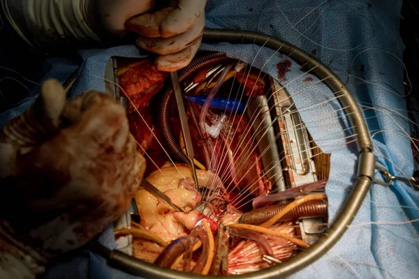 Durante Cirurgia Cardíaca Aberta Válvula Cardíaca Com Defeito Tem Ser — Fotografia de Stock