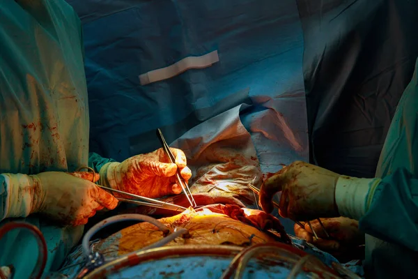 Kranskärl Bypass Transplantat Cabg För Hjärtoperationer Grund Sjukdom Kranskärlssjukdom Sjukhusoperationssalen — Stockfoto