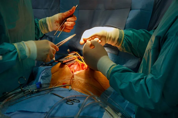 由于心脏瓣膜故障而进行开胸手术 瓣膜置换在医院手术室进行 — 图库照片