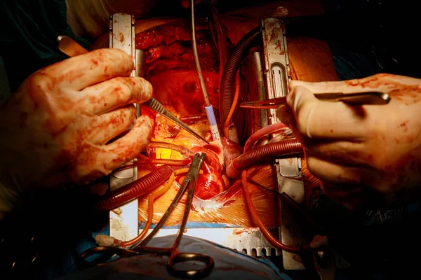 Cabg カビグ 病院の手術室における冠動脈心疾患による心臓手術のバイパス手術の一種 — ストック写真