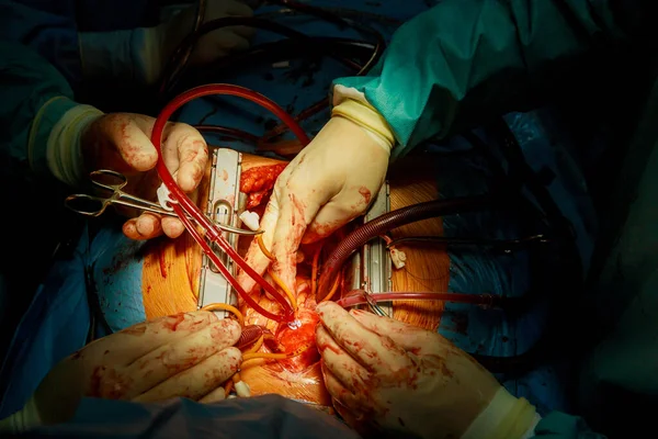 Hjärtklaffsbyte Operationssalen Krävs När Det Finns Funktionsstörning Hjärtklaffen Som Kräver — Stockfoto