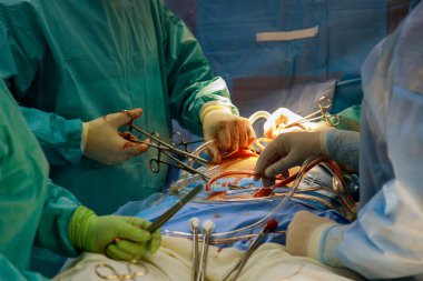 Ameliyat için koroner arter bypass bypass greft CABG koroner kalp hastalığı nedeniyle bir kalp hastanede bir ameliyathane