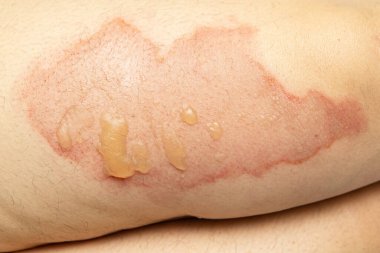 Korkunç bir yanıkla bacağını kapat. Deride sıcak sudan sonra yaralanma. Evdeki kaza, yanma yarası. Dikkatsiz bir kavram. Acil yardım gerekiyor..