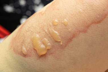 Korkunç bir yanıkla bacağını kapat. Deride sıcak sudan sonra yaralanma. Evdeki kaza, yanma yarası. Dikkatsiz bir kavram. Acil yardım gerekiyor..