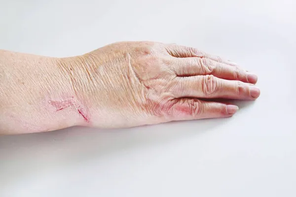 Jedna ręka starszej kobiety z zadrapaniami i siniakami zbliżenie — Zdjęcie stockowe
