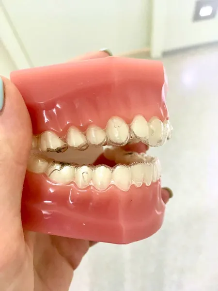 Aligners Worn Demo Model Analogue Braces Beautiful Bite Correction Dentistry — Stock Photo, Image