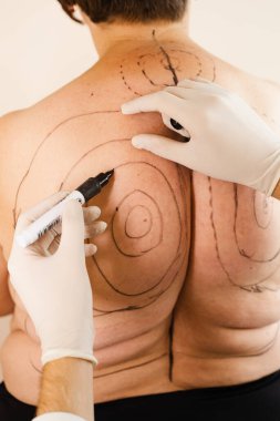 Kirfoz sırt ağrısı. Liposuction ameliyatından önce. Dul kambur ameliyatla alınıyor.