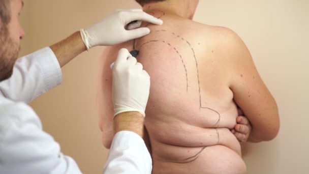 Markup kövér nő előtt Kyphosis műtét. Özvegy púp. A sebész most jelöli vissza a nő zsírleszívás műtét — Stock videók