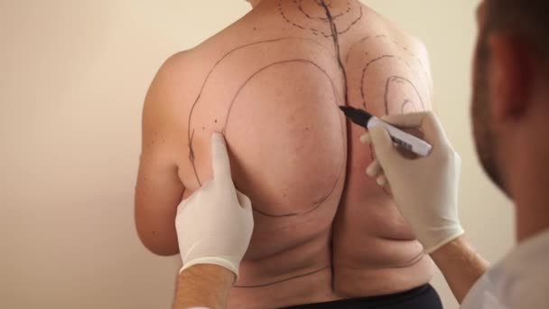 Markup for liposuction surgery. Kyphosis. Removing dowager hump. Obesity of woman. — Stock Video