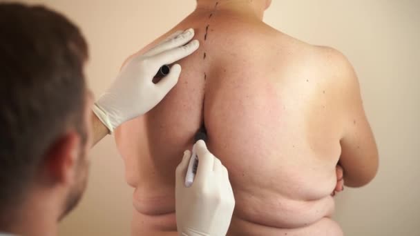 Kyphosis bolesti zad. Značka před operací liposukce. Chirurgické odstranění vdovy hrbaté. — Stock video