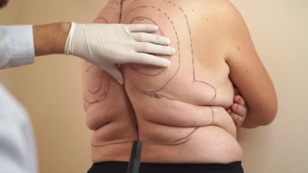 Tulang belakang Markup wanita gemuk untuk operasi sedot lemak. Kyphosis. Surgigal penghapusan punuk janda. — Stok Video