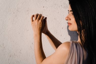 Gürcü güzel bir kadının ellerinde vitiligo derisi pigmentasyonu. Deri mevsimsel hastalıklar. Kız ellerini vitiligo lekeleriyle kaplamış olarak görüyor.