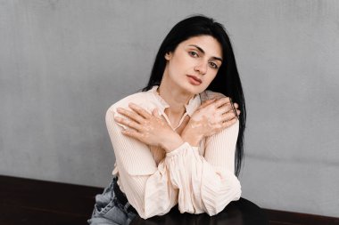 Çekici bir kadın vitiligo pigmentasyonuyla el ele tutuşuyor. Deri hastalıkları olan yaşam tarzı