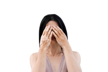 Ellerinde vitiligo pigmentasyon bantları olan kadın ellerini beyaz arka planda tutarak yüzünü kapatıyor. Deri hastalıkları olan yaşam tarzı