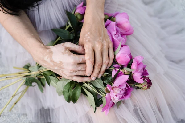 Hands with vitiligo skin pigmentation and bouquet of flowers peonies. Skin seasonal diseases