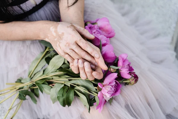 紫色の肌の色素沈着と花の牡丹の花束と手 皮膚病 — ストック写真