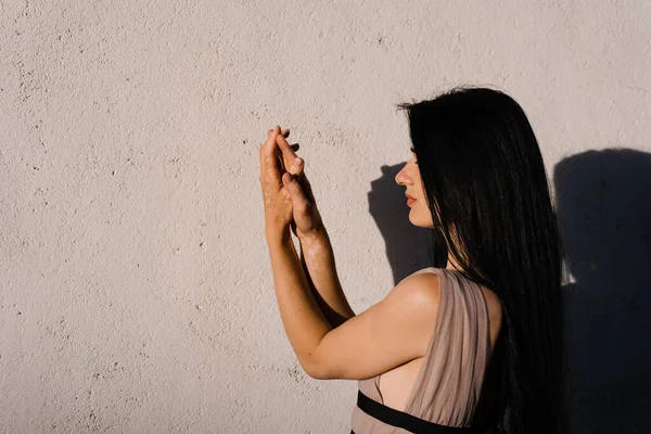 Pigmentacja Skóry Vitiligo Rękach Pięknej Gruzińskiej Kobiety Choroby Sezonowe Skóry — Zdjęcie stockowe