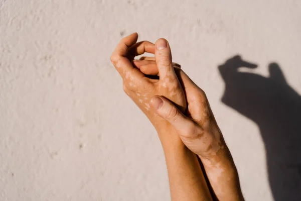 Vitiligo skin pigmentation on the hands of woman. Skin seasonal diseases