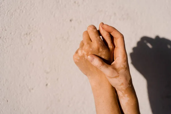 Vitiligo Pigmentação Pele Nas Mãos Mulher Doenças Sazonais Pele — Fotografia de Stock