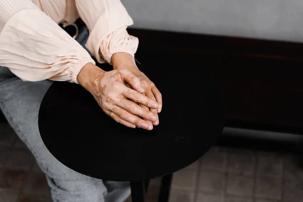 Hands with vitiligo skin pigmentation on black background close-up. Lifestyle with Seasonal skin diseases