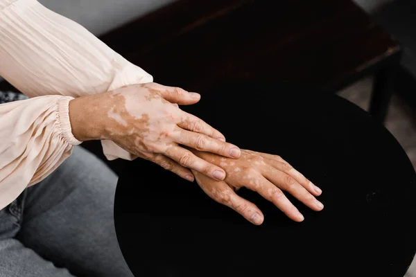 Hands with vitiligo skin pigmentation on black background close-up. Lifestyle with Seasonal skin diseases