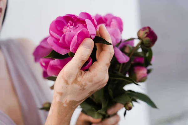 Hands with vitiligo skin pigmentation and bouquet of flowers peonies. Skin seasonal diseases