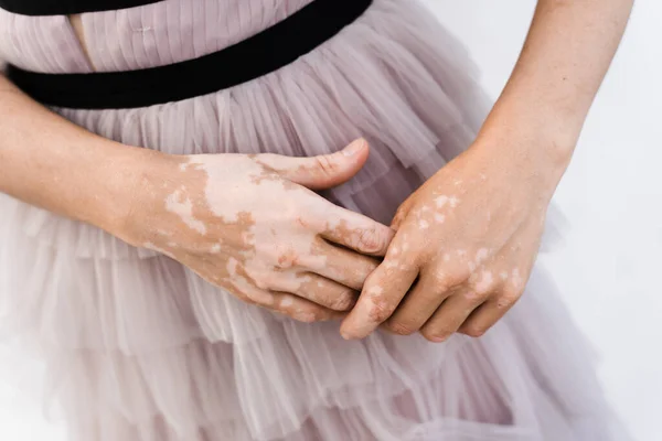 Hands with vitiligo skin pigmentation. Lifestyle with Seasonal skin diseases