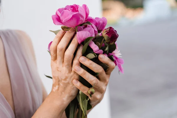 Hands with vitiligo skin pigmentation and bouquet of flowers peonies. Skin seasonal diseases