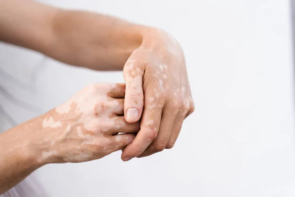 Hands with vitiligo skin pigmentation on white background close-up. Lifestyle with Seasonal skin diseases