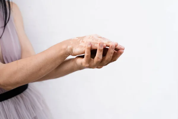 Hands with vitiligo skin pigmentation on white background close-up. Lifestyle with Seasonal skin diseases