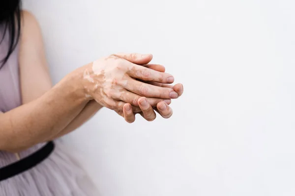 Hands with vitiligo skin pigmentation on white background close-up. Lifestyle with Seasonal skin diseases