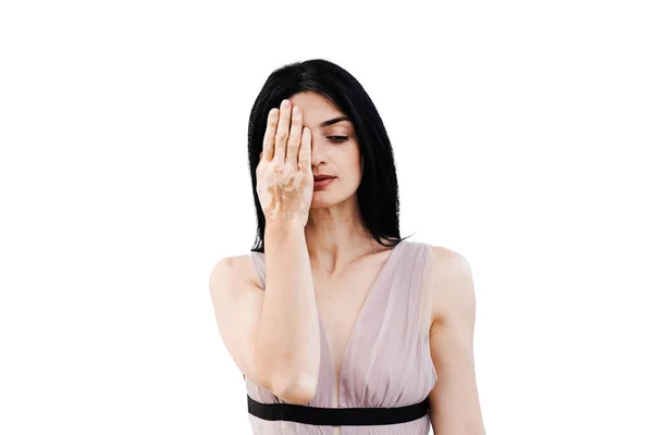 Kobieta Plamami Pigmentacyjnymi Rękach Zakrywa Twarz Dłońmi Białym Tle Styl — Zdjęcie stockowe