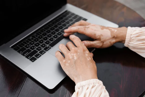 Girl with vitiligo skin pigmentation on the hands typing on laptop online close-up. Skin seasonal disease