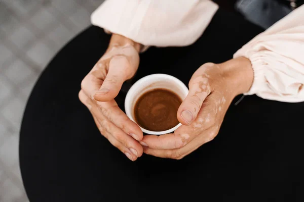 Hands with vitiligo skin pigmentation holding cup of coffee on black background close-up. Lifestyle with skin seasonal diseases