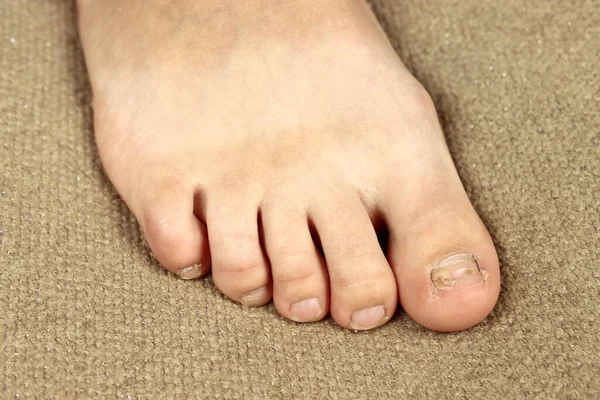 Fungus or toenail disease, nail close-up
