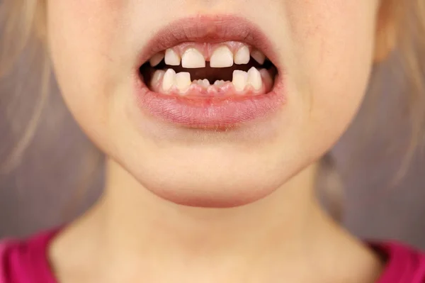 Child Mouth Two Front Teeth Loss Baby Teeth — Stock Photo, Image