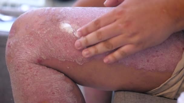 Hombre Que Aplica Crema Alivio Psoriasis Concepto Médico Atención Médica — Vídeo de stock