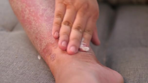 乾癬の救済クリームを適用する男 医学と医療の概念 皮膚の発疹を持つ男 — ストック動画