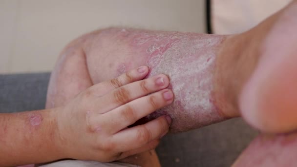 Der Mann Der Psoriasis Lindernde Creme Anwendet Medizin Und Gesundheitskonzept — Stockvideo