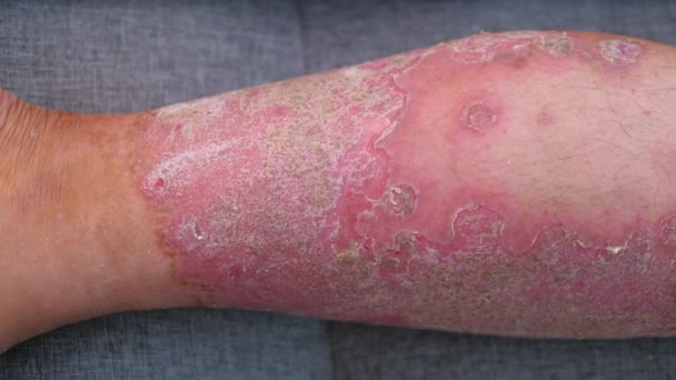 Muž Který Aplikuje Psoriázu Odlehčení Krém Lékařská Zdravotní Péče Koncept — Stock video