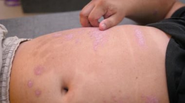 Sedef hastalığı önleyici krem, sağlık ve tıbbi bakım konsepti uygulayan adam deri döküntüsü olan adam.