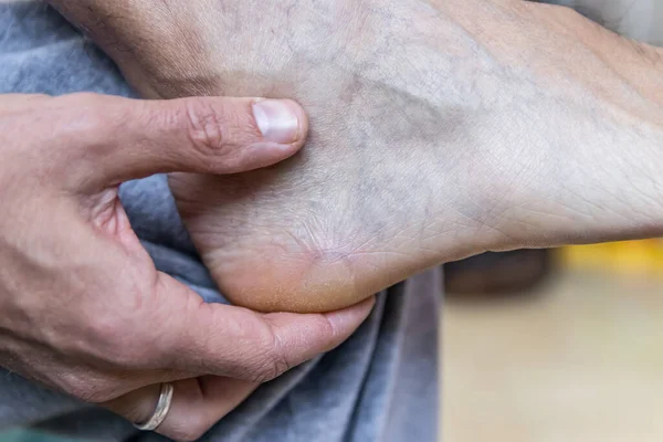 Blisters on the foot of a Caucasian man sitting on the couch at home