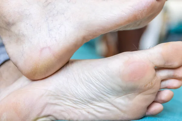 Blisters on the foot of a Caucasian man sitting on the couch at home