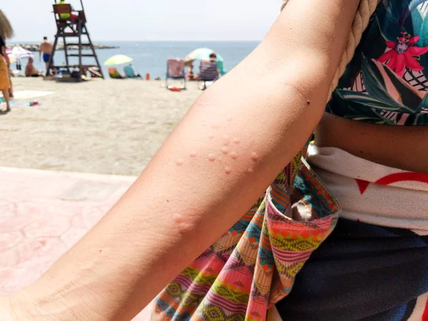 Jellyfish Sting Arm Woman Beach Horizontal — Photo