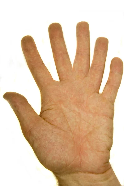 Palma de hombre con seis dedos —  Fotos de Stock