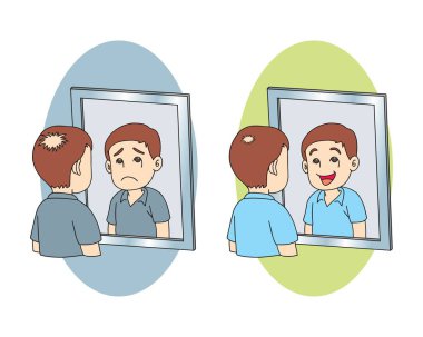 Orta yaşlı, alopecia sorunu olan bir adam. Saç tedavisi ve naklinden önce ve sonra. Saç dökülmesi konsepti. Vektör illüstrasyonu karikatür el çizimi