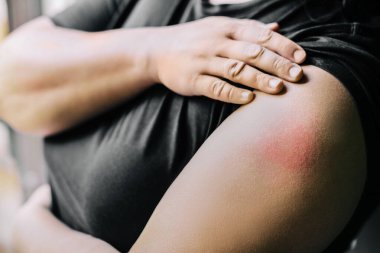 Aşı yapıldıktan sonra şişmiş kırmızı şırınga. Covid-19 koronovirüs aşısından 48 saat sonra kadının kolu.