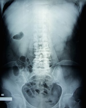 bir kadının pelvis röntgen filmi