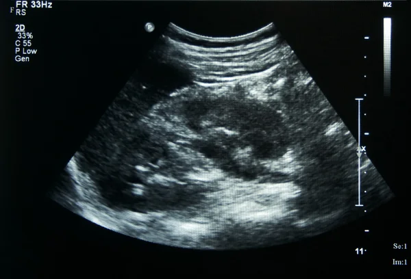 Film Ultrasound dari ginjal wanita — Stok Foto